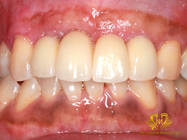 前歯の多数歯欠損のインプラント症例
