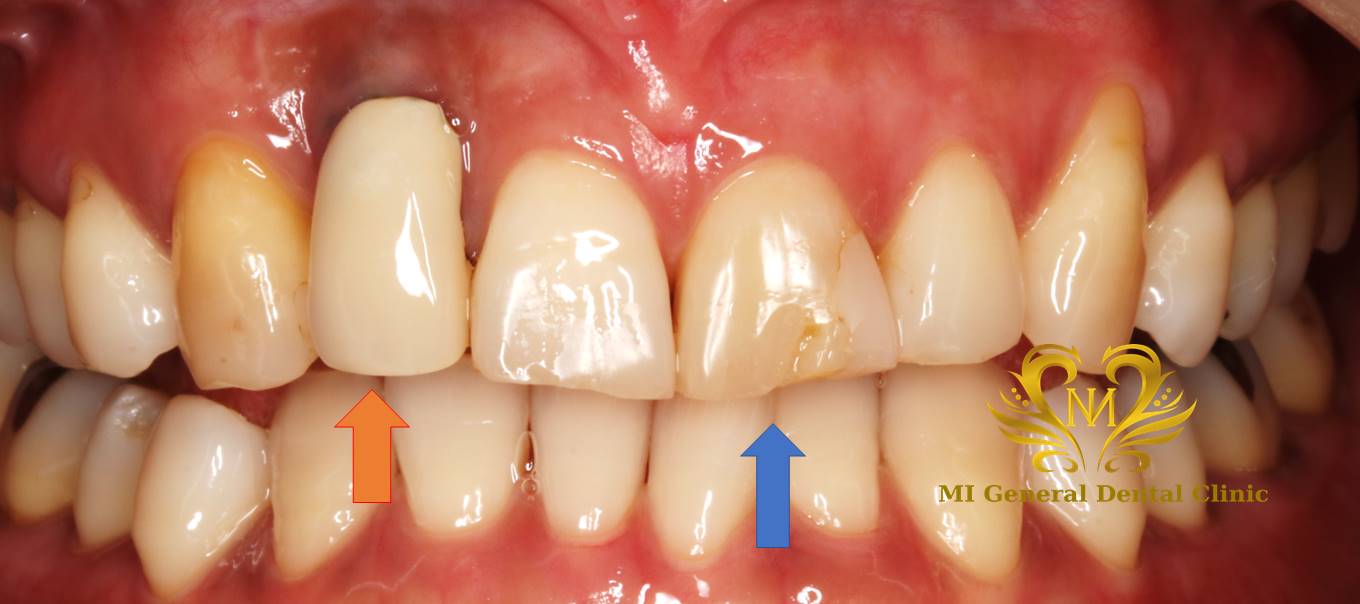 左上の前歯の抜歯即時インプラント症例