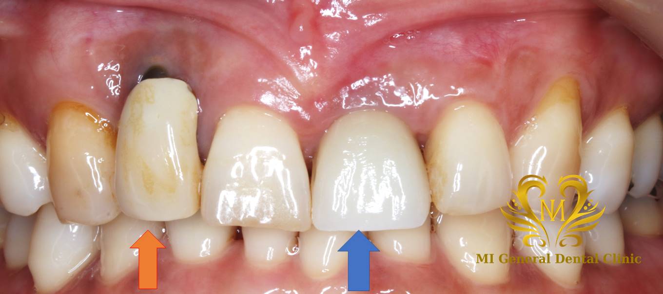 左上の前歯の抜歯即時インプラント症例