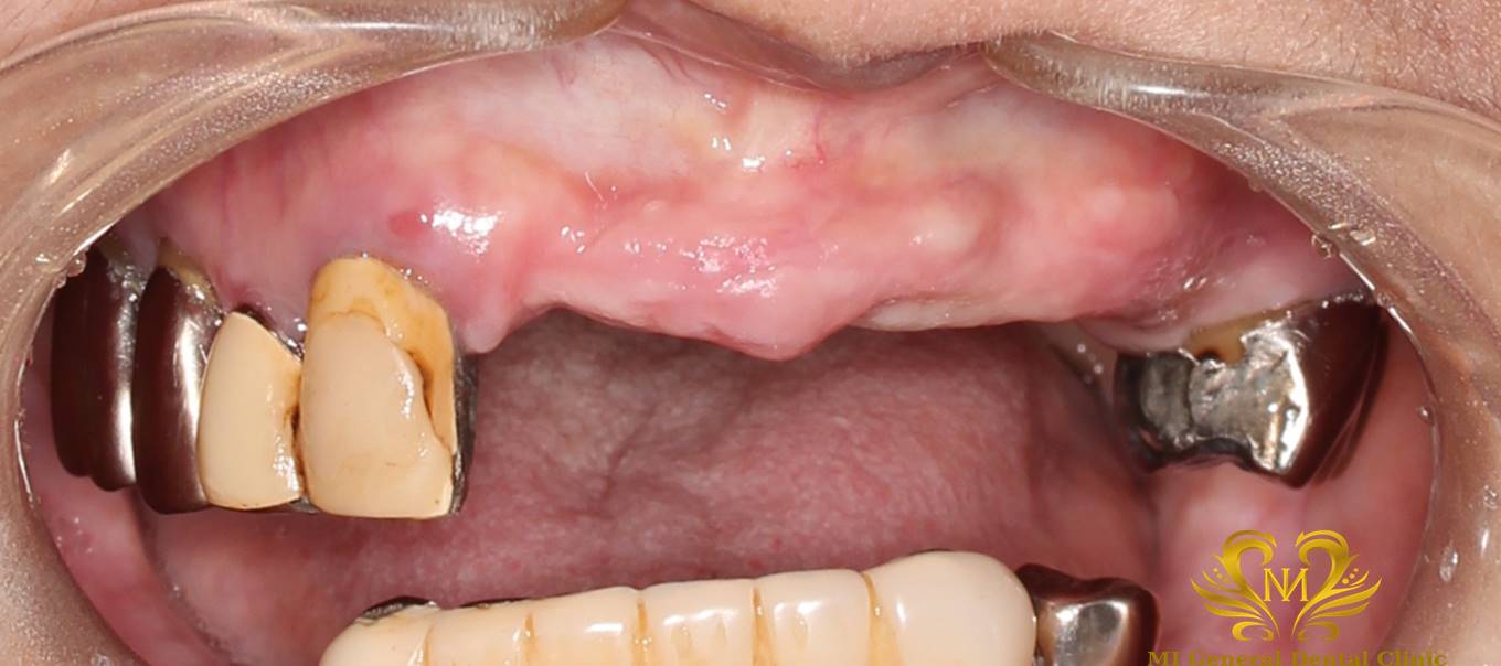 上顎前歯のインプラント（ブリッジ）