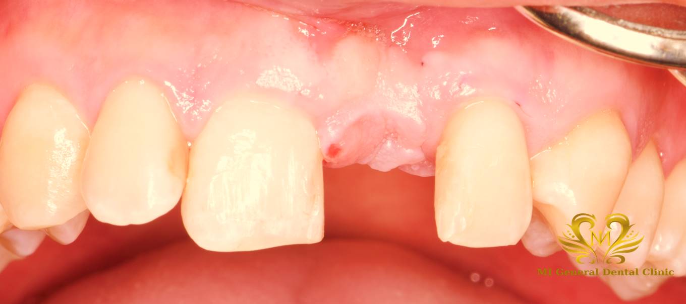 前歯のインプラント治療
