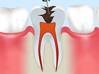 虫歯菌に汚染された神経や血管を根管内から取り除きます。