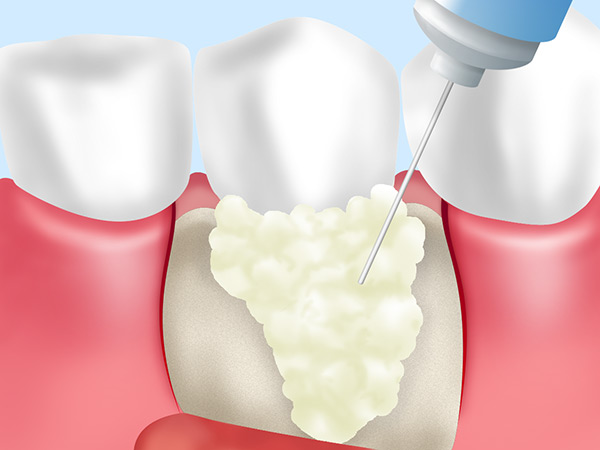 歯周組織再生療法（保険適応）