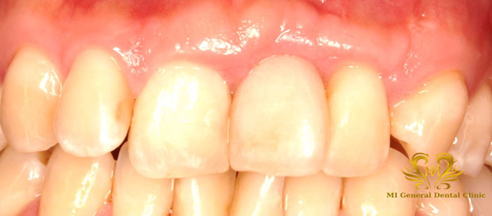 骨造成処置でインプラント治療をご提案