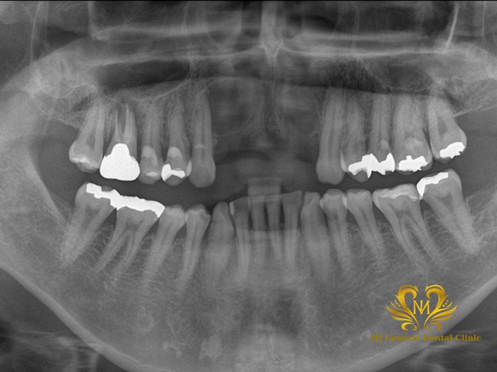 前歯の多数歯欠損のインプラント症例