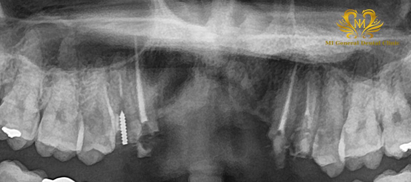 前歯の多数歯欠損のインプラント症例