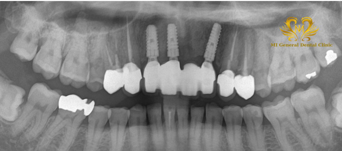 前歯の多数歯欠損のインプラント症例