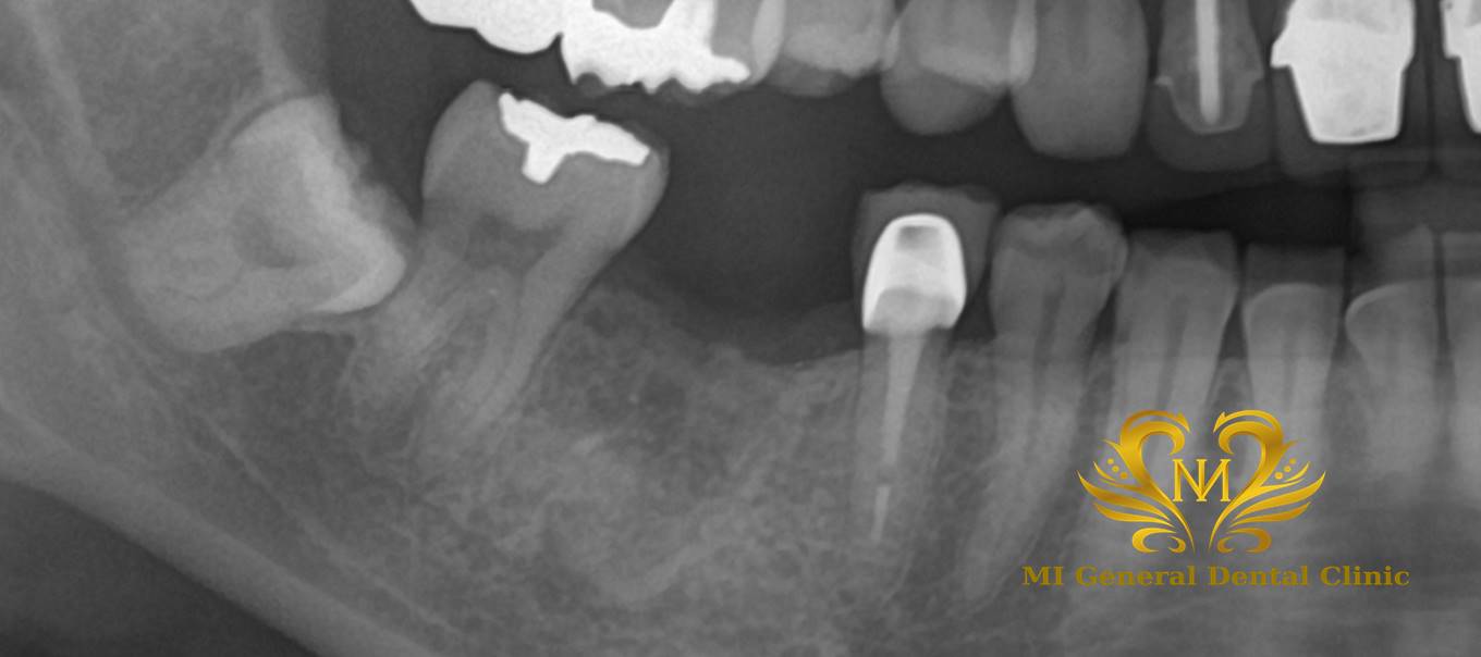 奥歯のインプラント治療