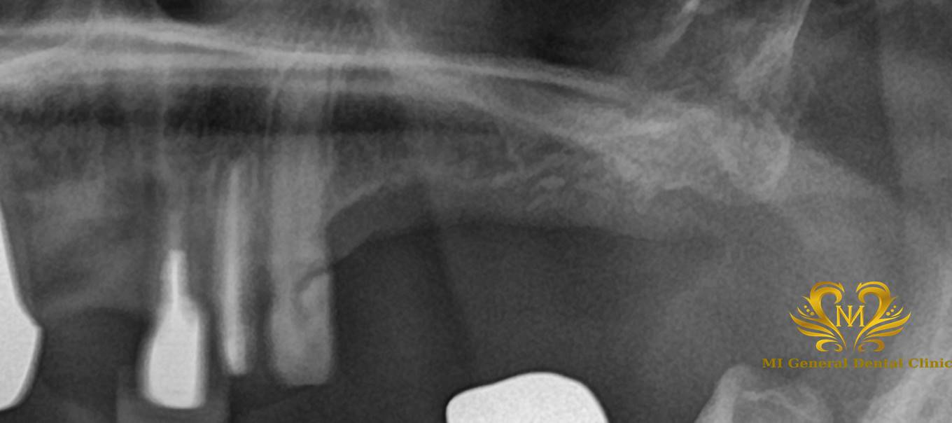 左上奥歯のインプラント治療