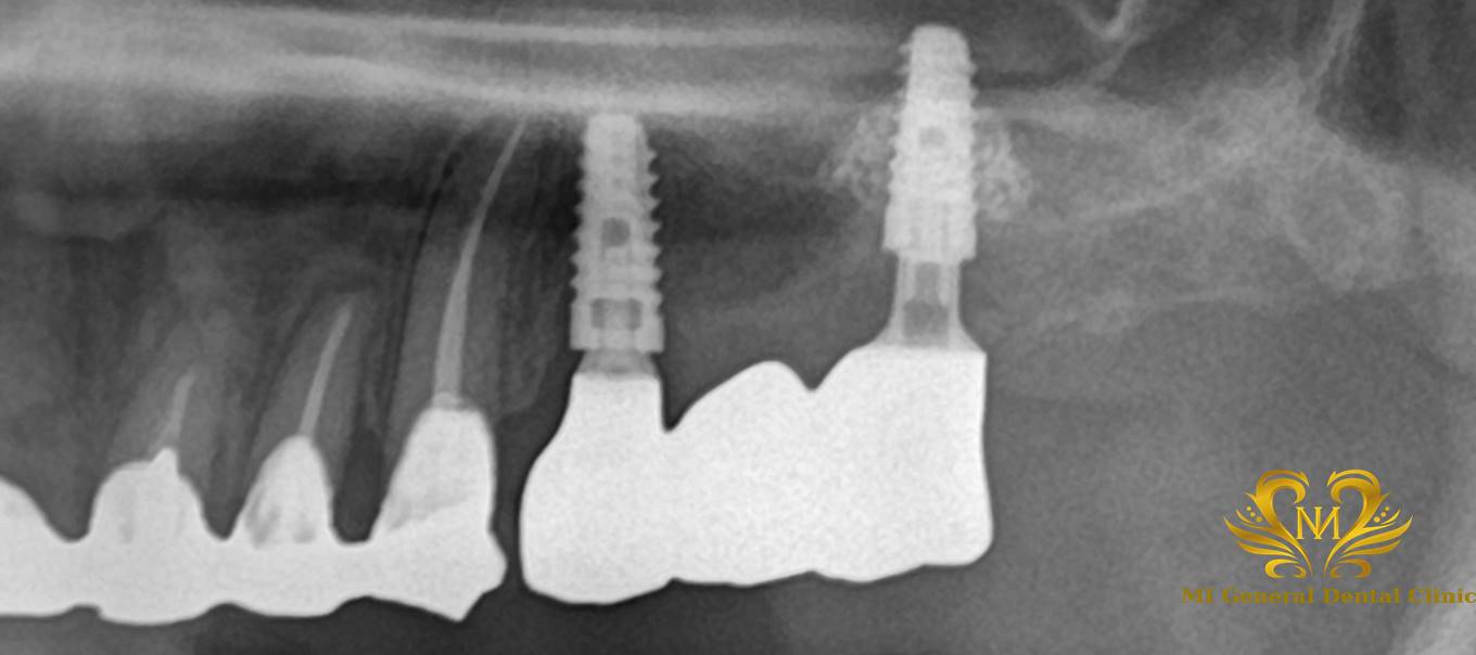 左上奥歯のインプラント治療